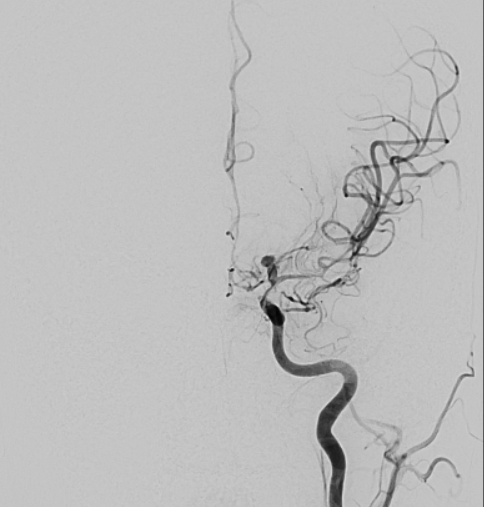 Figure 1. Non-contrast CT head demonstrating subarachnoid hemorrhage predominantly involving the anterior interhemispheric cistern.